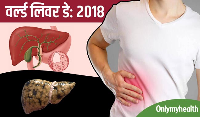 वर्ल्ड लिवर डे: शराब नहीं पीने वालों को भी होता है फैटी लिवर का खतरा, ये हैं लक्षण